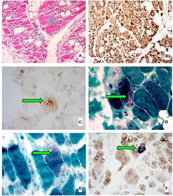 Impact of a Ketogenic Diet on Sporadic Inclusion Body Myositis: A Case Study